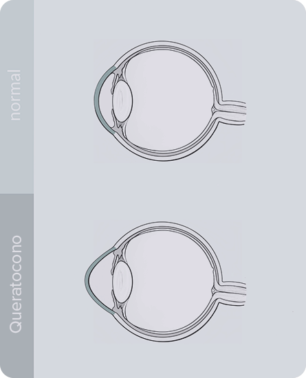 Tratamiento Crosslinking